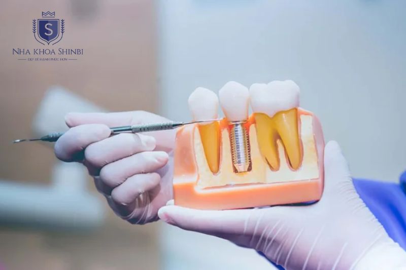Bệnh nhân cấy ghép Implant Dentium không cảm thấy đau trong quá trình cấy trụ