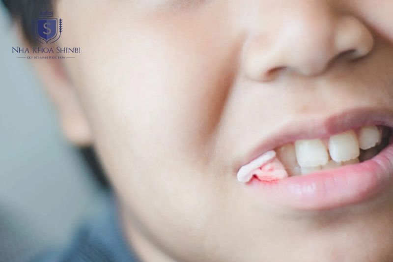 Cầm máu chườm lạnh và súc nước muối giúp kiểm soát chảy máu chân răng tạm thời