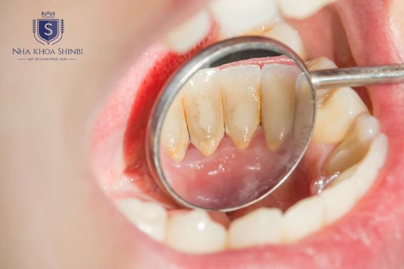 Cao răng tích tụ kéo dài gây viêm nướu mạn tính và chảy máu chân răng tái diễn