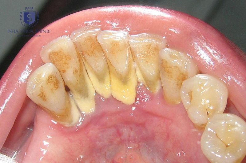 Cao răng tích tụ lâu ngày kéo theo viêm nướu