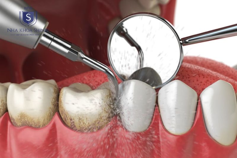 Cạo vôi và làm sạch gốc răng là nền tảng điều trị viêm nha chu nhẹ đến trung bình