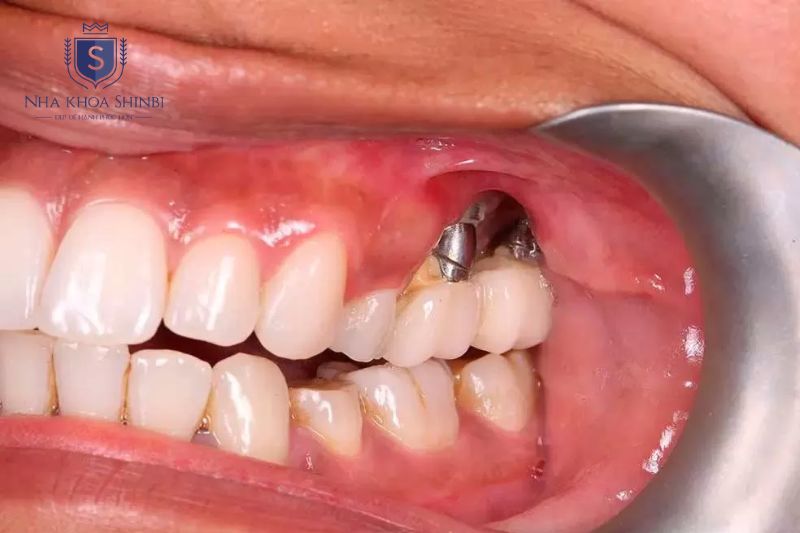 Cấy ghép Implant cần bác sĩ chuyên môn để giảm nguy cơ biến chứng