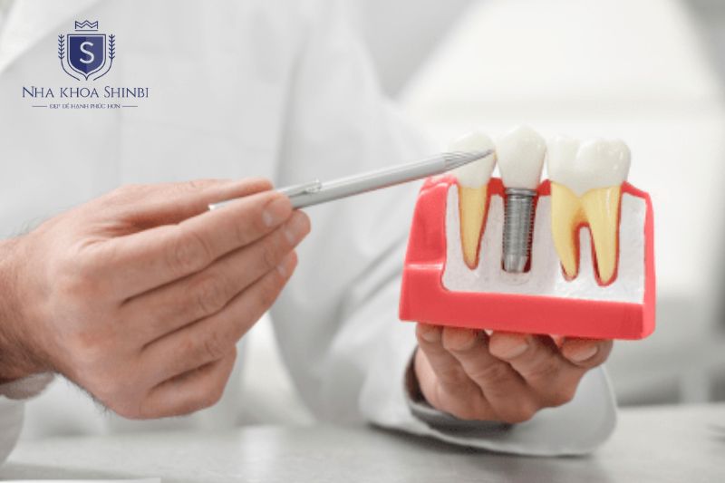 Cấy ghép Implant là thuật ngữ chỉ toàn bộ quy trình trồng răng Implant hoàn chỉnh