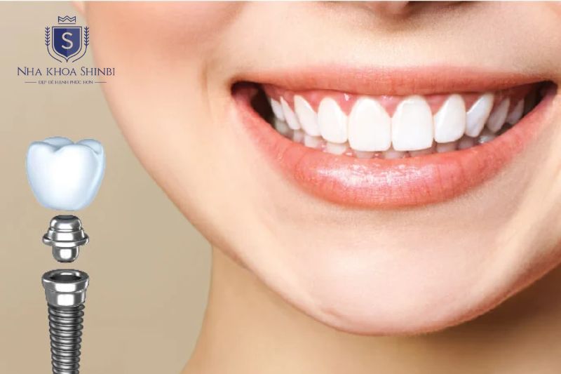 Cấy ghép implant là phương pháp duy nhất có thể tái tạo lực nhai truyền xuống xương