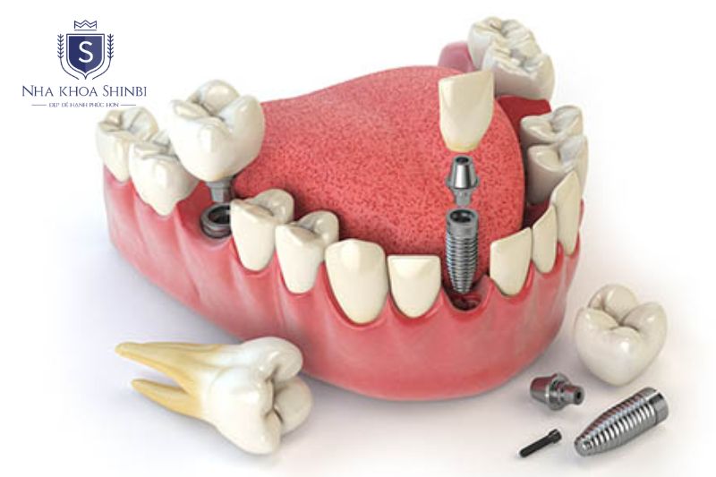 Cấy implant ngay sau khi nhổ răng để rút ngắn thời gian trồng răng implant an toàn