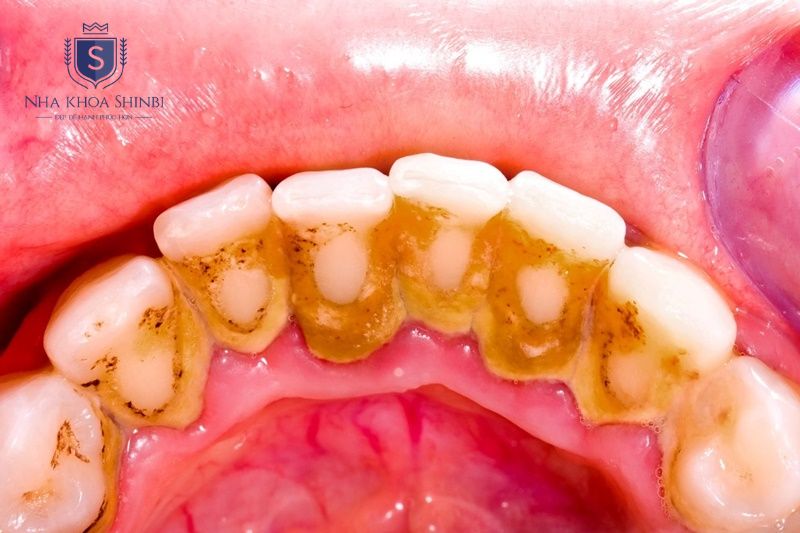 Chăm sóc răng sai cách khiến mảng bám tích tụ và tổn thương nướu gây viêm