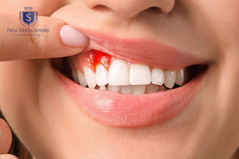 Chảy máu chân răng kéo dài có thể gây mất răng và ảnh hưởng sức khỏe toàn thân