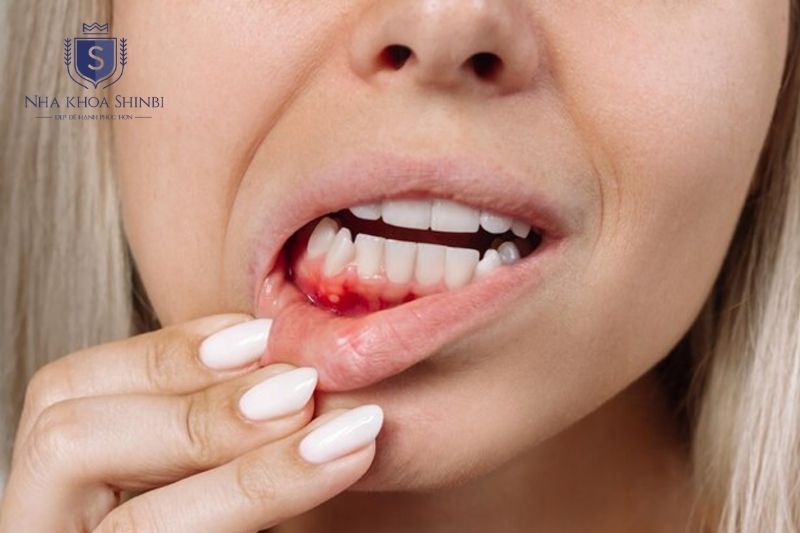 Chảy máu chân răng kéo dài kèm sốt hoặc chóng mặt cần được thăm khám y tế sớm