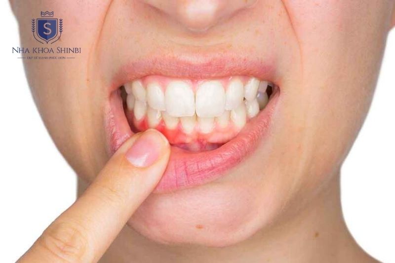 Chảy máu chân răng kéo dài kèm tụt nướu hoặc lung lay răng cần khám nha khoa sớm