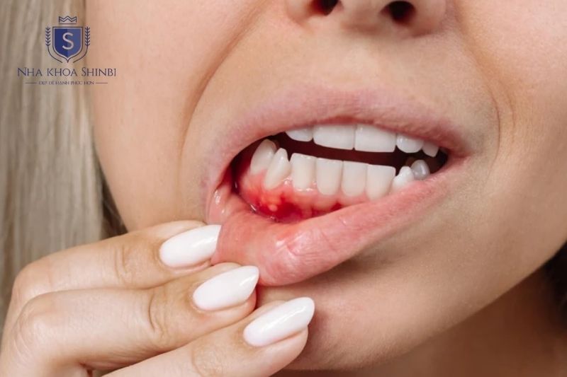 Chảy máu chân răng là dấu hiệu viêm nướu hoặc bệnh lý cần được xử lý đúng nguyên nhân
