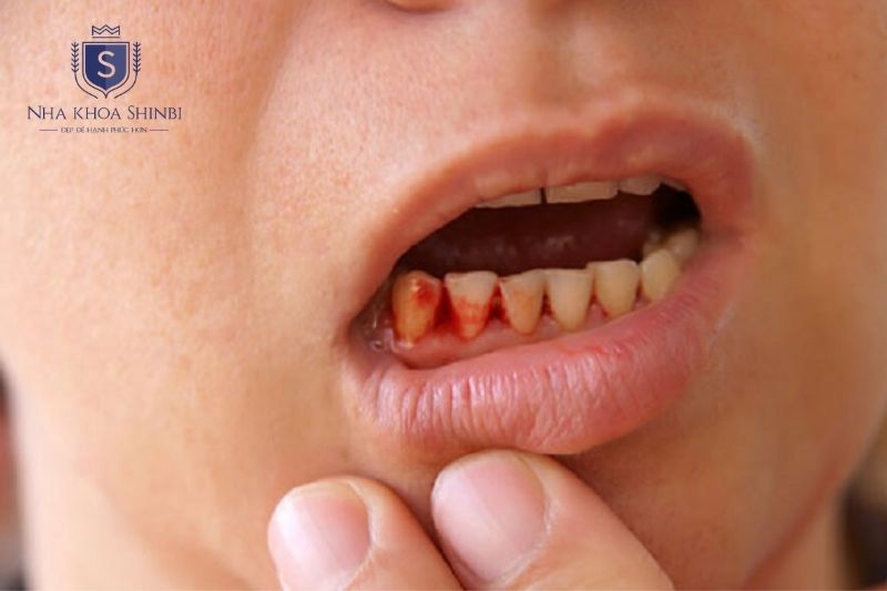 Chảy máu chân răng là tình trạng máu rỉ ra từ mô nướu xung quanh chân răng