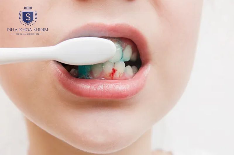 Chảy máu nướu và răng lung lay là dấu hiệu cảnh báo viêm nha chu sớm