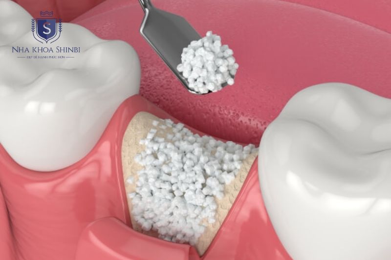 Chi phí Implant tăng khi ghép xương, nhiều răng, sứ cao cấp tại Nha Khoa Shinbi