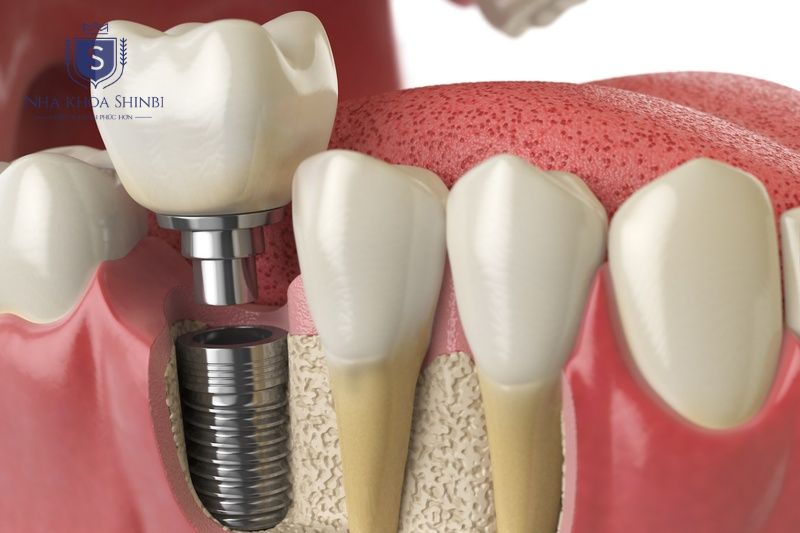 Chi phí cho trụ Implant Neo Biotech tùy thuộc vào gói dịch vụ tại mỗi cơ sở nha khoa