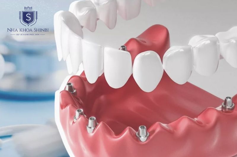 Chọn dòng trụ implant Mỹ theo tình trạng xương và phác đồ