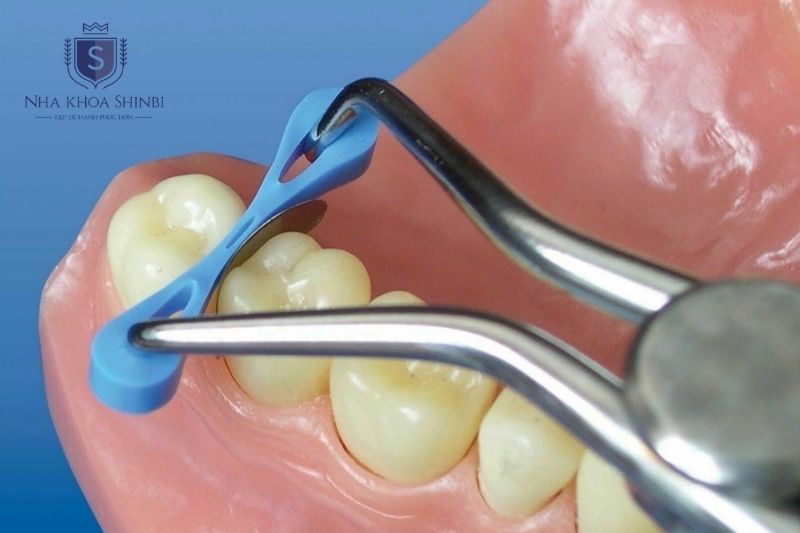 Chun tách kẽ thường gây ê nhức vài ngày đầu do tạo khoảng trống giữa các răng hàm