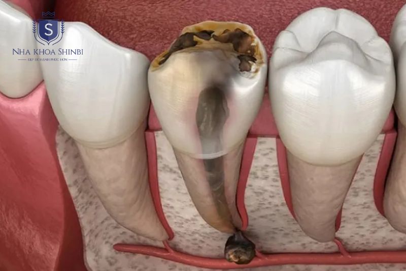 Đau tự phát và ê buốt kéo dài là dấu hiệu cảnh báo viêm tủy tiến triển