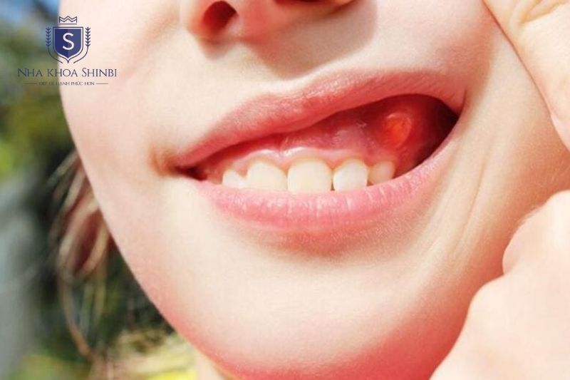 Điều trị áp xe răng gồm dẫn lưu mủ cấp tính và xử lý nguyên nhân triệt để