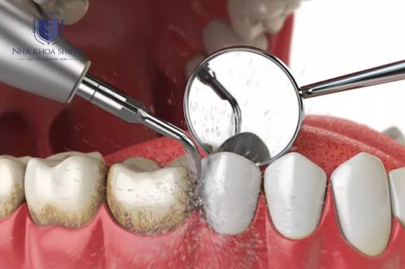 Điều trị nguyên nhân gồm làm sạch cao răng nha chu và nội nha giúp ổn định răng