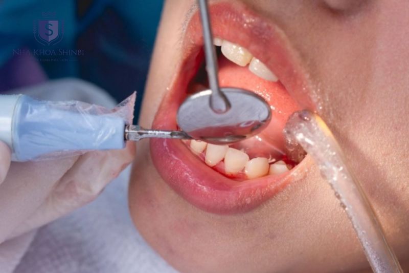Điều trị nha khoa gồm lấy cao răng xử lý nha chu và dùng kháng sinh khi cần thiết