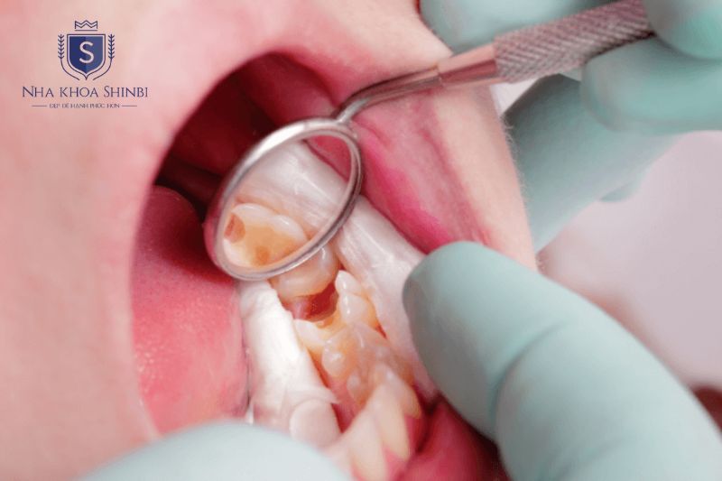 Điều trị nội nha giúp loại bỏ vi khuẩn và bảo tồn răng thật hiệu quả