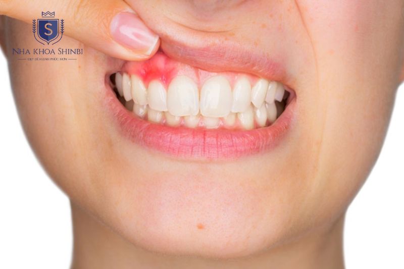 Điều trị sớm giúp hạn chế mất răng và bảo tồn xương hàm lâu dài