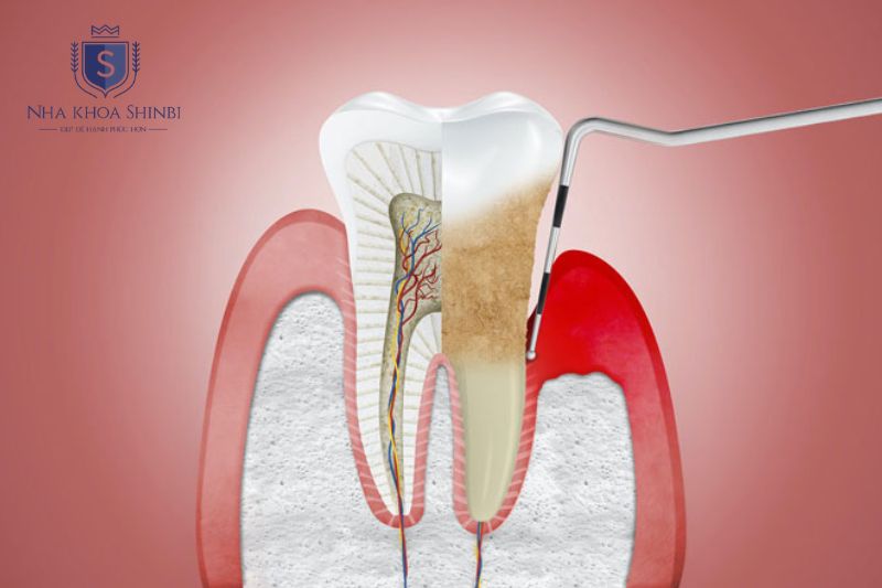 Đo túi nha chu và chụp X quang giúp xác định mức độ tổn thương nha chu