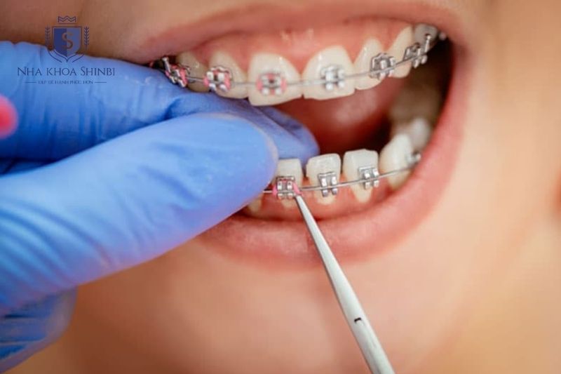 Ê buốt sau mỗi lần siết niềng thường giảm dần khi răng và mô nha chu thích nghi với lực chỉnh nha