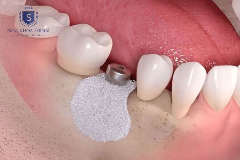 Ghép xương và mô nướu giúp tái tạo nâng đỡ răng khi tiêu xương còn bảo tồn