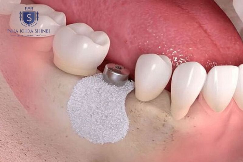 Ghép xương và nâng xoang được chỉ định khi xương hàm không đủ cấy implant