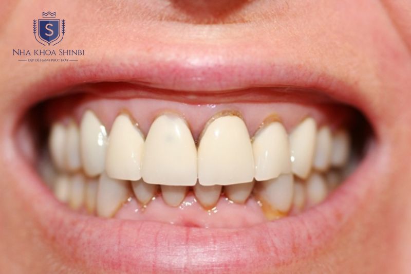 Giai đoạn mất khoáng gây đốm trắng trên men răng và có thể tái khoáng nếu xử lý sớm
