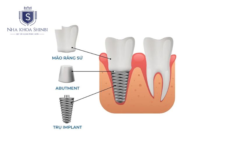 Hệ thống Implant gồm trụ Implant, Abutment và mão răng sứ hoàn chỉnh chức năng răng thay thế