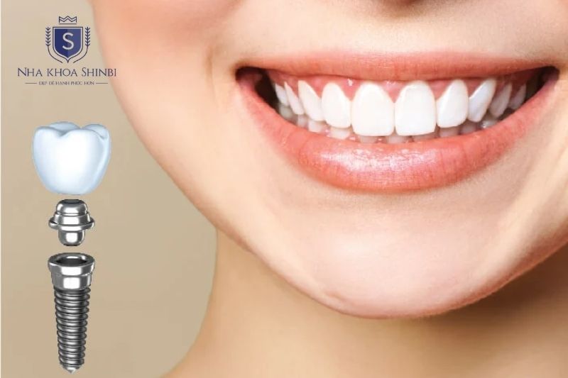 Implant an toàn khi thực hiện đúng chỉ định với bác sĩ và thiết bị đạt chuẩn