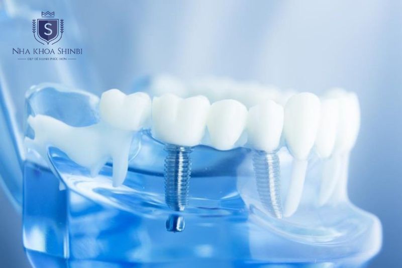 Implant giúp phục hồi lực nhai và ngăn tiêu xương tiếp tục tiến triển hiệu quả
