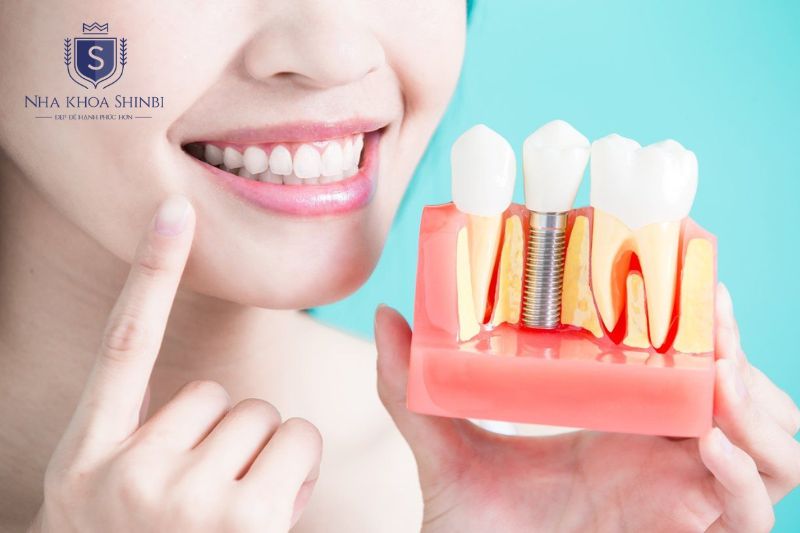Implant là giải pháp phục hình bền vững khi răng viêm tủy không thể giữ lại