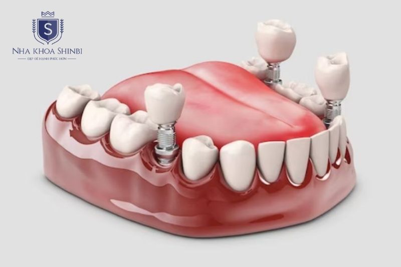 Implant là giải pháp phục hình hiệu quả khi đáp ứng đúng điều kiện y khoa