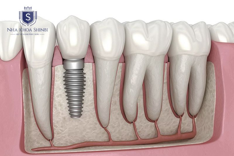 Implant là giải pháp phục hình hiệu quả sau mất răng do viêm nha chu