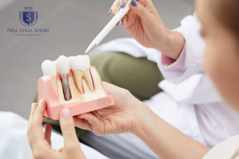 Implant là giải pháp phục hồi mất răng số 6 giúp ngăn tiêu xương và bảo tồn răng kế cận lâu dài