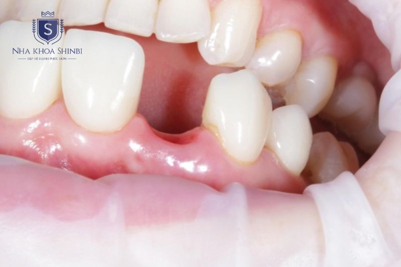 Implant phù hợp người mất răng trưởng thành cần đánh giá xương hàm