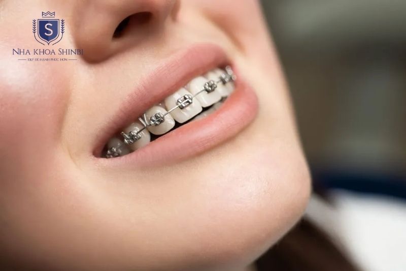 Invisalign thường ít đau hơn mắc cài kim loại do lực nhẹ và ít cọ xát mô mềm