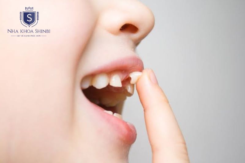 Khả năng giữ răng lung lay phụ thuộc nguyên nhân mức độ tổn thương và thời điểm điều trị