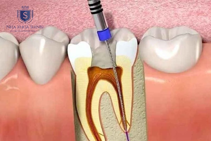 Lấy tủy hiện đại không đau và thường hoàn thành sau vài lần hẹn