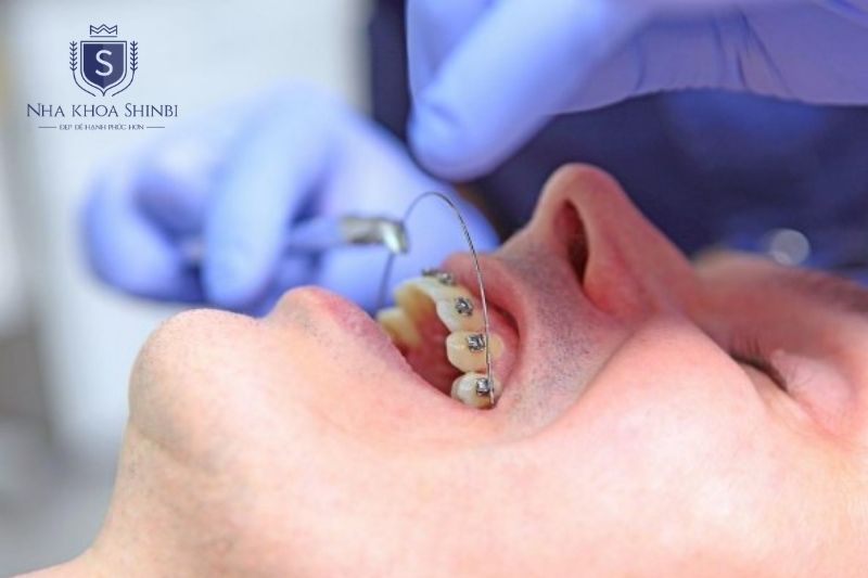 Mắc cài thường không gây đau khi gắn nhưng có thể gây ê buốt và cộm trong vài tuần đầu