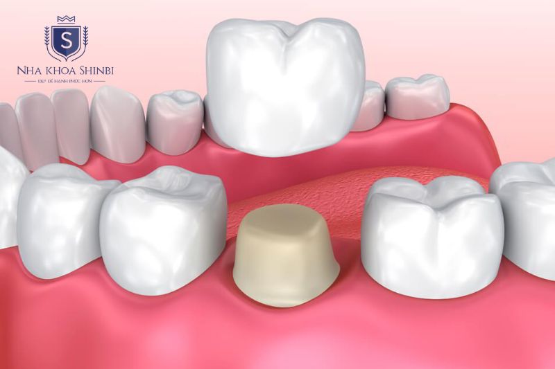 Mão răng sứ là phần nhìn thấy được của cấu tạo implant, được chế tác theo khuôn hàm từng bệnh nhân