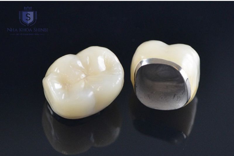 Mão toàn sứ hay sứ kim loại phù hợp cho implant tùy vào vị trí và yêu cầu khác nhau