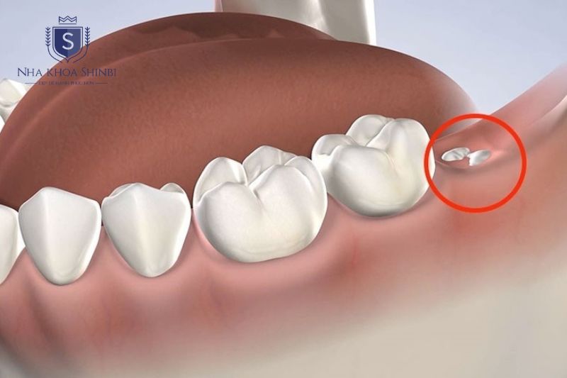 Mất răng đơn lẻ đến toàn hàm chọn Implant theo nhu cầu phục hình