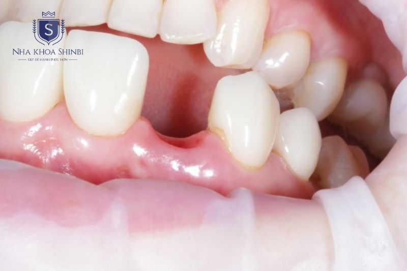 Mất răng làm xương hàm mất lực nhai kích thích và bắt đầu tiêu biến từ tháng thứ ba
