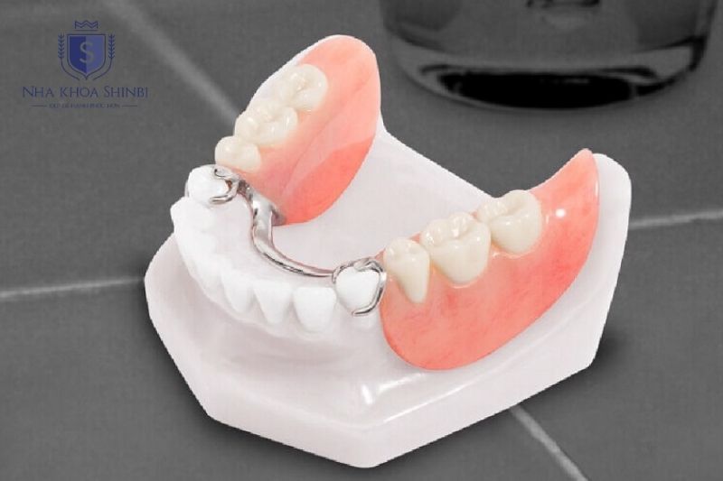 Mất răng số 6 cần phục hình sớm để hạn chế tiêu xương và lệch khớp cắn lâu dài