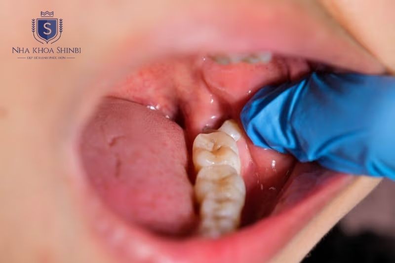 Mất răng số 6 kéo dài có thể gây tiêu xương, lệch khớp cắn và mất thêm răng kế cận