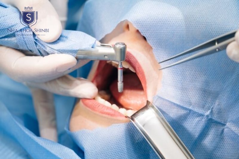 Nha Khoa Shinbi hỗ trợ đánh giá và điều trị tiêu xương hàm bằng công nghệ CT 3D